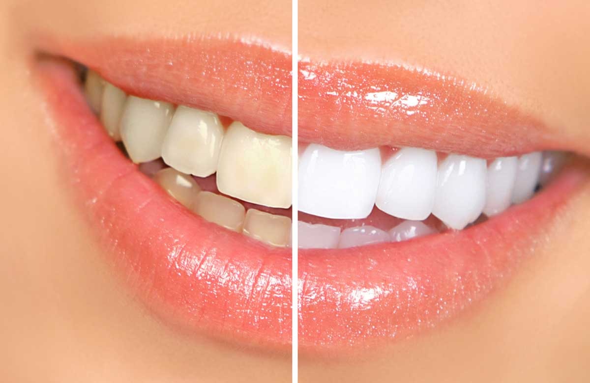 TEETH WHITENING