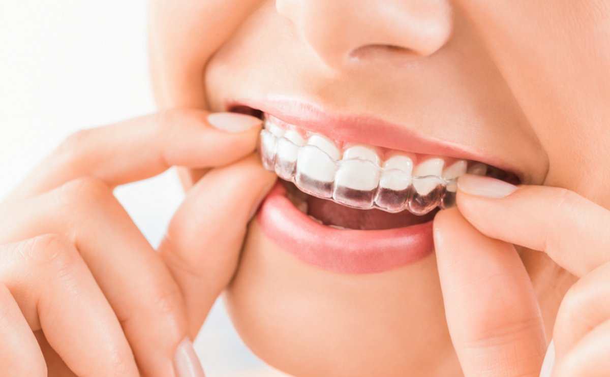 BRACE TREATMENT (ORTHODONTICS)