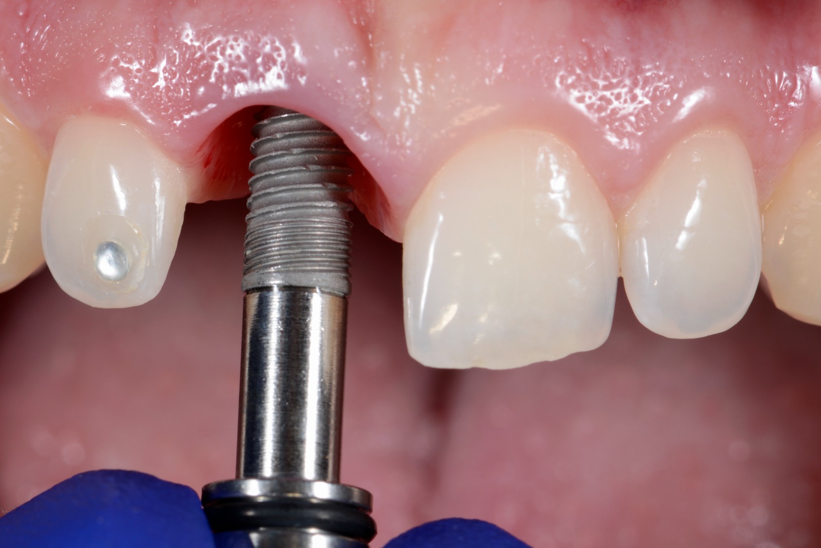 IMPLANT TREATMENT